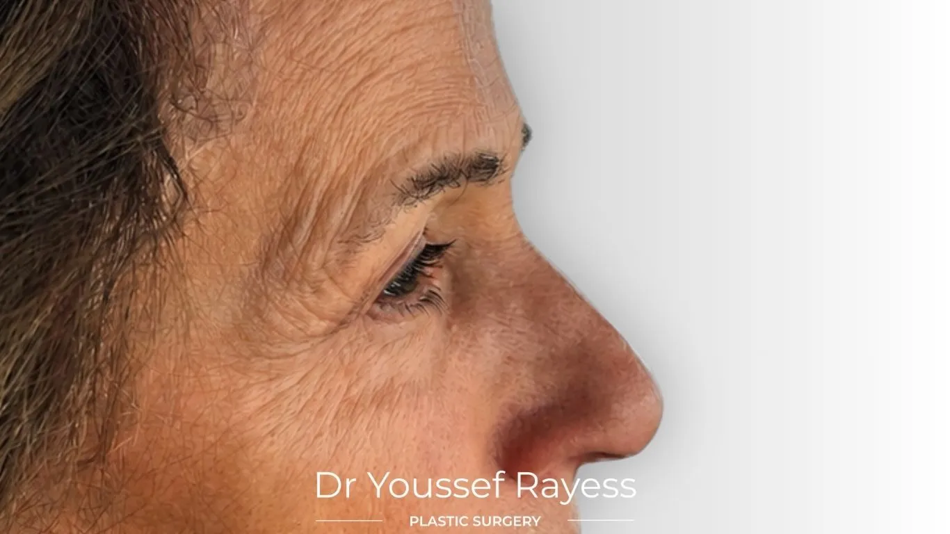 Side view before brow lift result by Dr Youssef Rayess in Beirut and Dubai showing natural brow refinement and facial harmony